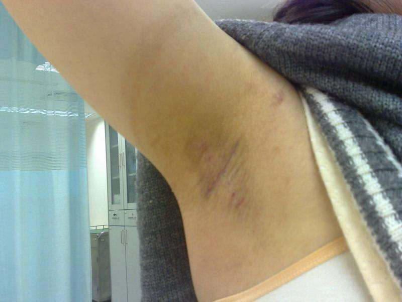 腋臭患者怎样进行护理