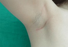 男性腋臭怎么预防